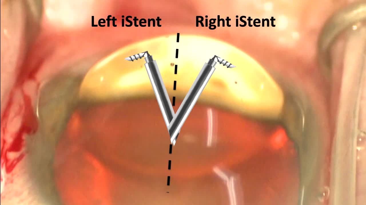Introduction to MIGS | Volume 36, Issue 1 - Video Journal of Cataract ...